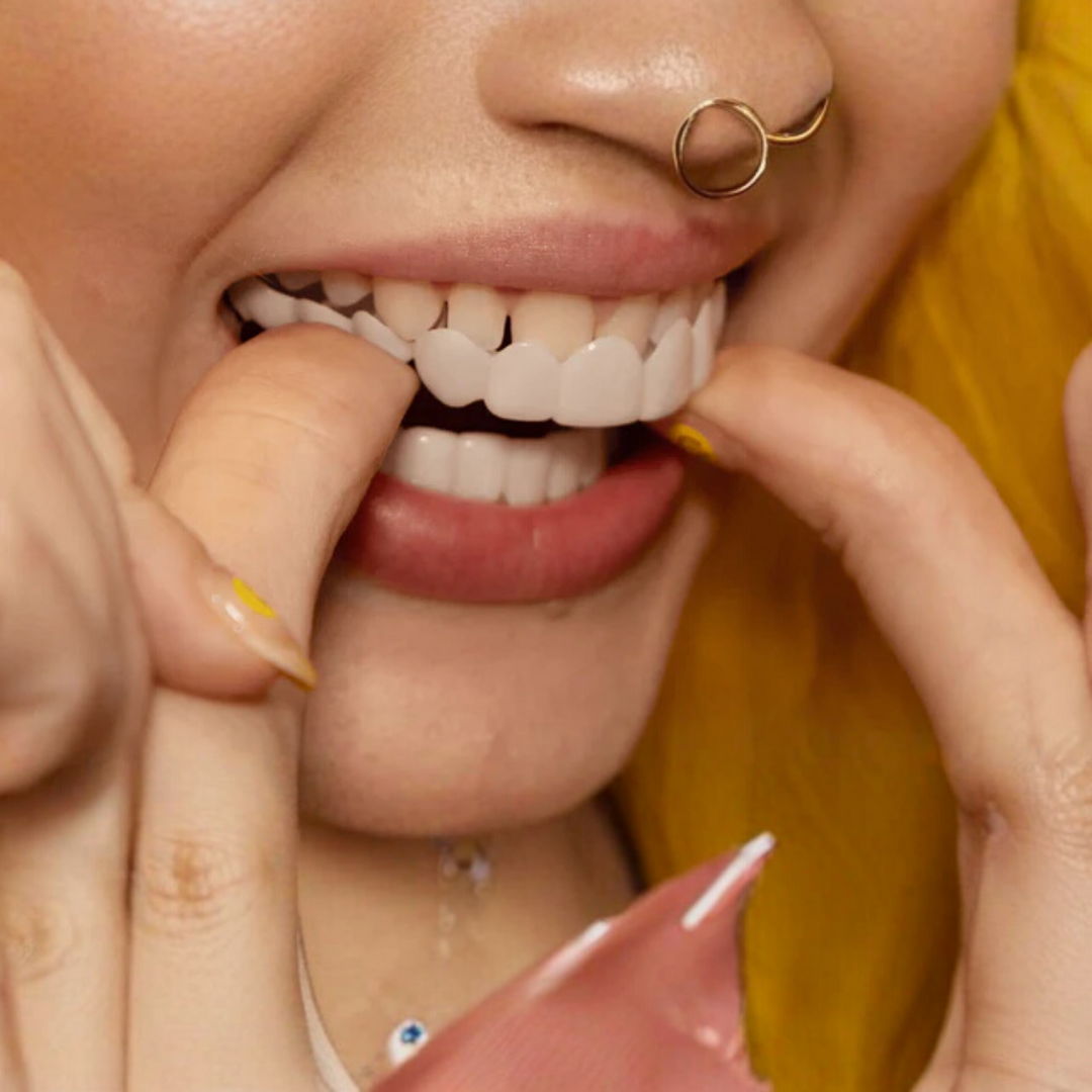 Licówki Snap-On Smile poprawiające uśmiech